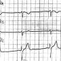 ekg-beispiel16c.jpg