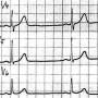 ekg-beispiel16d.jpg