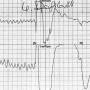 ekg-beispiel5c.jpg